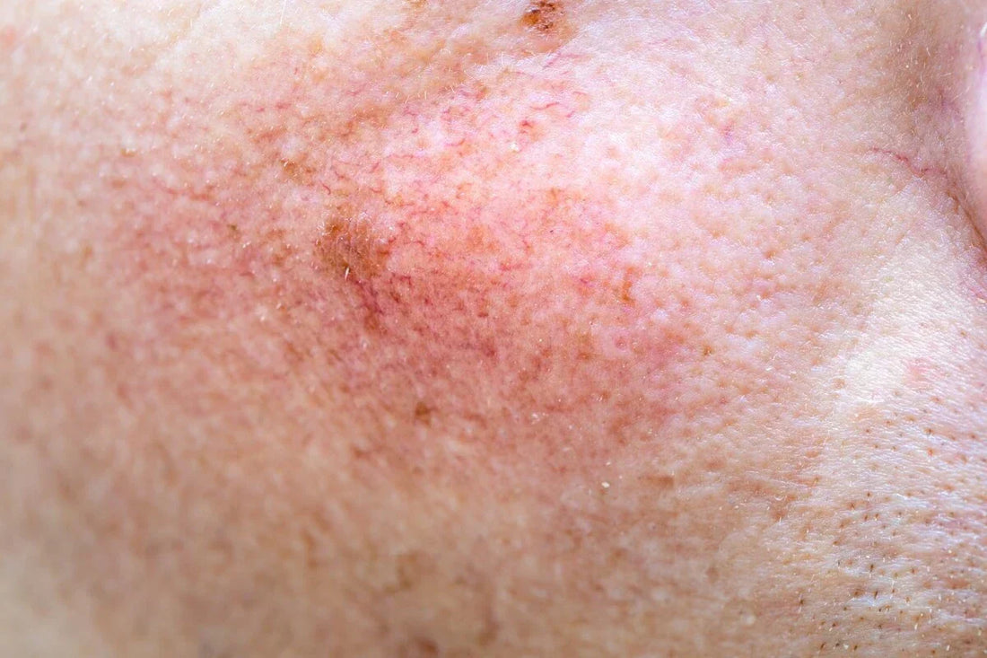 Retinol efekty uboczne - jak ich uniknąć? Bezpieczna alternatywa: Retinol H10 i Retinol roślinny Orientana